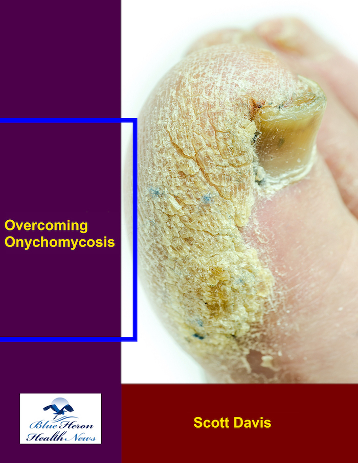 Overcoming Onychomycosis - Nail Fungus pricing