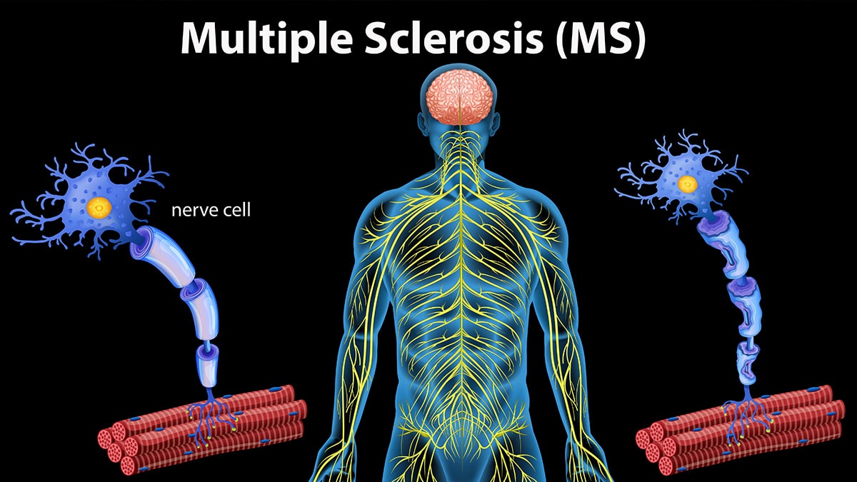 Multiple Sclerosis pricing