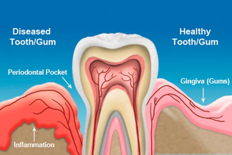 Gum Disease Gone pricing